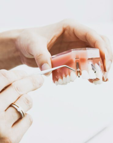 Dental-implant